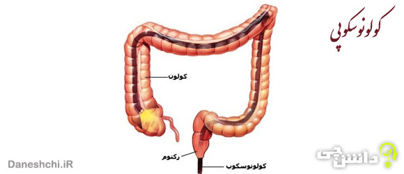 کاربرد کولونوسکوپی و عوارض بعد از آن