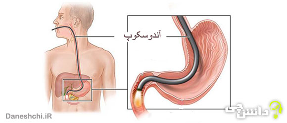 آندوسکوپی ( درون بینی ) چیست و چه کاربردی دارد؟