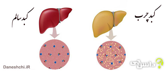 تحقیق در مورد کبد چرب 