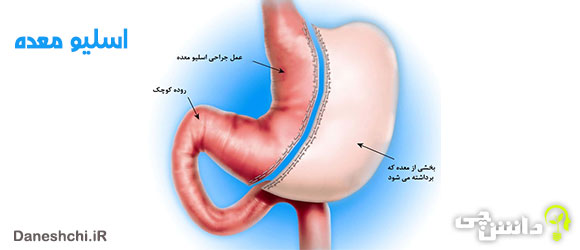 اسلیو معده