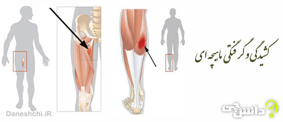 گرفتگی ماهیچه، کشیدگی ماهیچه و درد ماهیچه 